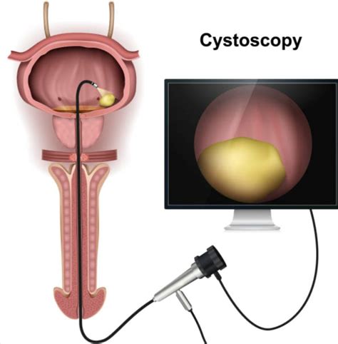 Image result for Cystoscopy Procedure