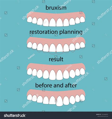 325 Attrition Tooth Images, Stock Photos & Vectors | Shutterstock