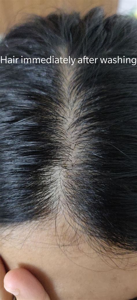 Scalp Dandruff 的图像结果