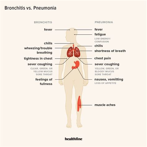 Bronchitis vs pneumonia how to tell – Artofit