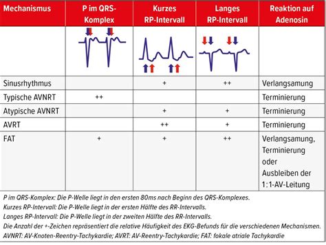 Supraventrikuläre Tachykardien - Kardiologie & Gefässmedizin ...