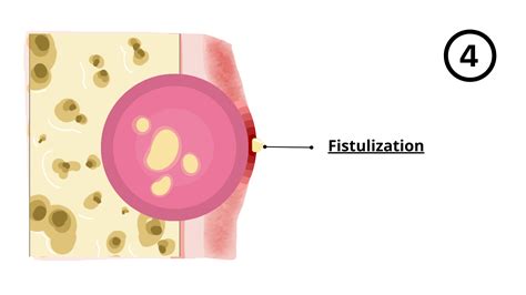 Wisdom Tooth Cyst Removal 的图像结果
