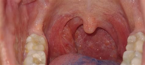 Pnd Sore Throat