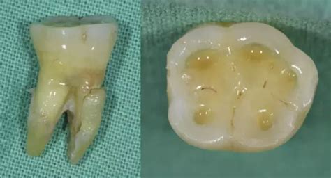 Prevalence of Vertical root fractures high among endodontically treated ...