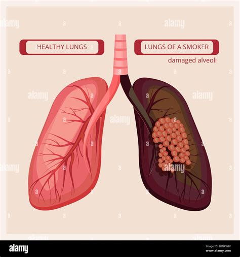 Smoker lungs. Smoke human damage lung cancer vector medical infographic pictures Stock Vector ...