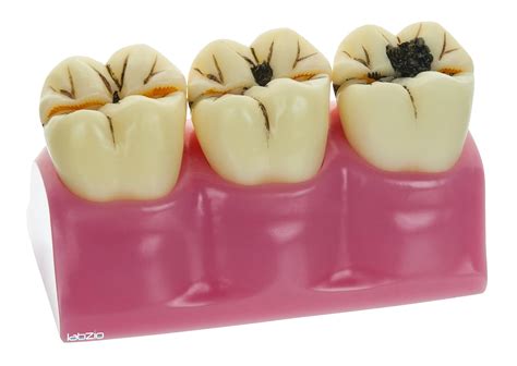 LABZIO by EISCO - Staged Model of Decaying Tooth, Removable and ...