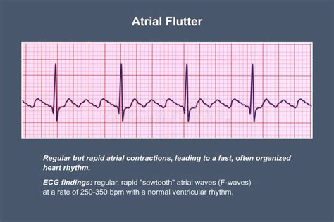 Image result for Atrial Flutter ECG Pattern