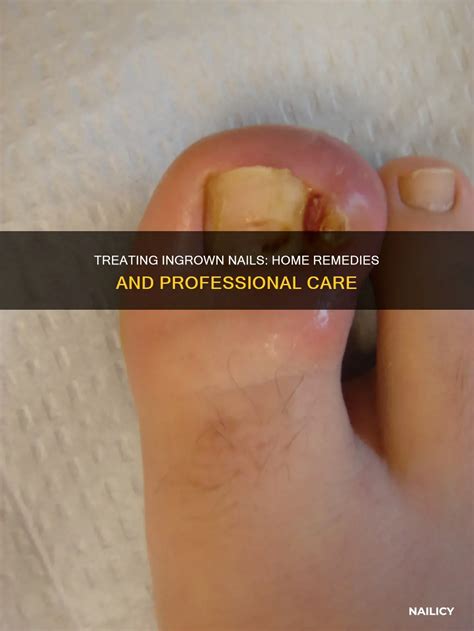 Ingrown Fingernail Treatment