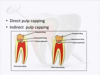 Image result for Direct Pulp Capping Vs RCT