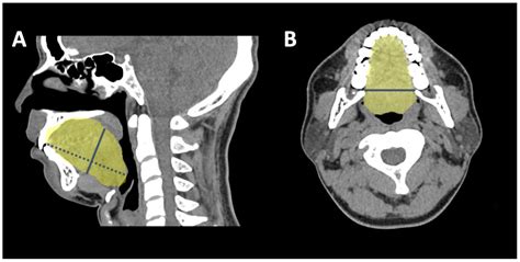 Volumetric Changes after Coblation Ablation Tongue (CAT) in Obstructive ...