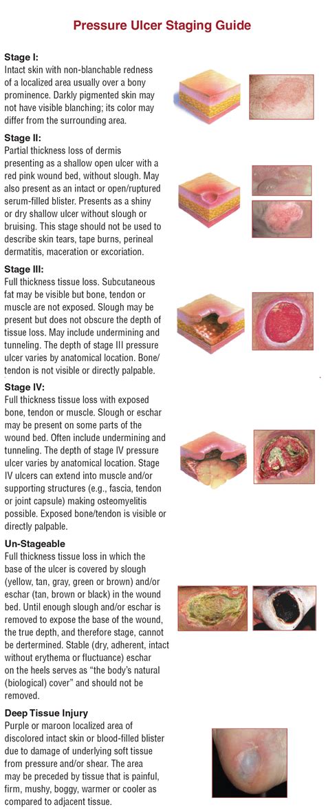 Pressure Ulcer Staging Guide