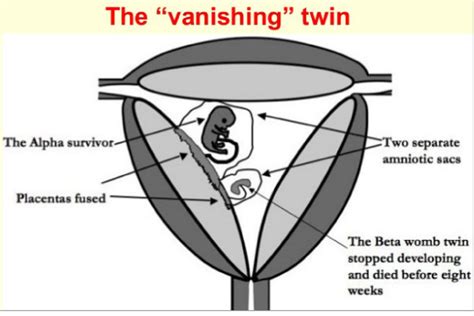 How Common Is Vanishing Twin Syndrome