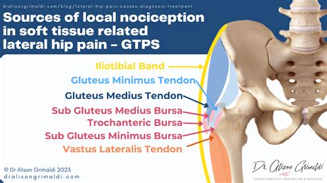 Best Treatment For Gluteal Tendinopathy/Trochanteric, 58% OFF