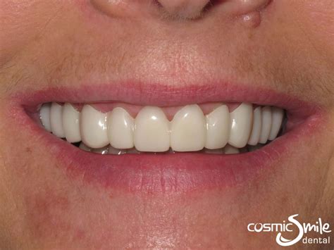 Dental Veneers Snap On at William Christy blog