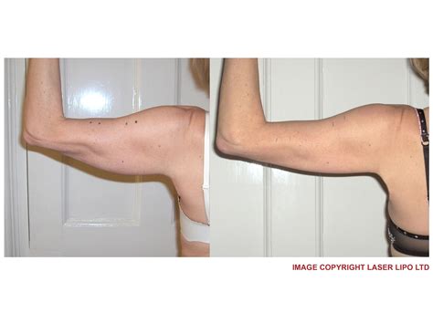 Pin by Lisa Hollins on Strawberry Laser Lipo before & after treatments | Laser lipo, Lipo, Lipo ...
