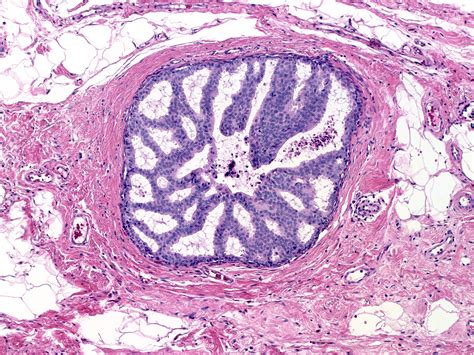 Atypical Ductal Hyperplasia (ADH) - MGH Learn Pathology