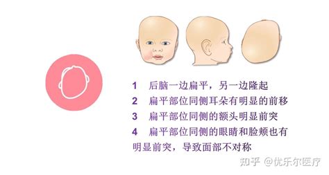 婴儿颅骨畸形基本知识