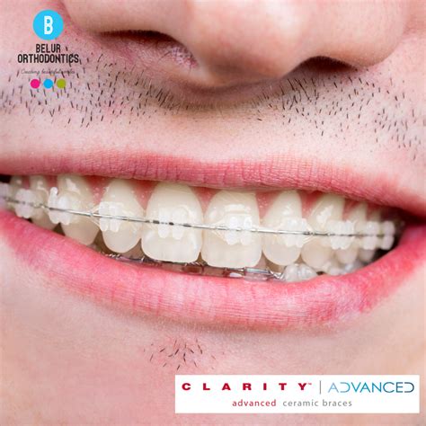 Clear Braces Before And After