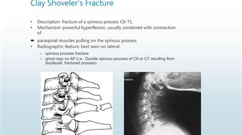 Radiographic anatomy and views of c spine | PPTX