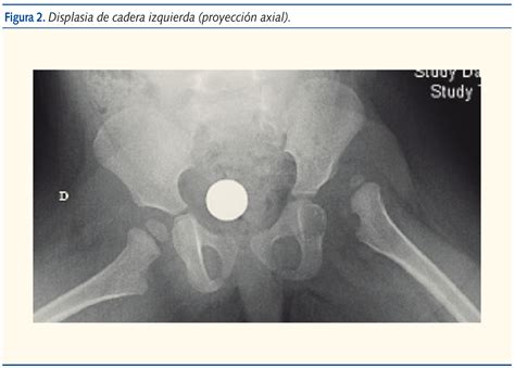 Revista de Pediatría de Atención Primaria - Displasia evolutiva de ...