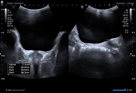 Volume of the normal prostate gland in polish boys, aged 1–17 years: Based on transabdominal ...