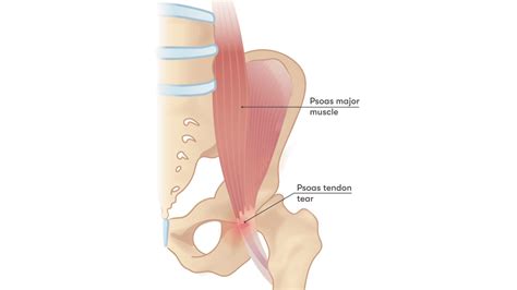 Can you tear your psoas muscle? - ANF