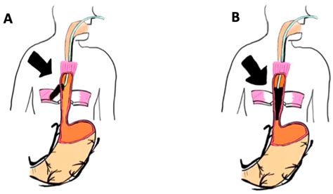 Endoluminal Vacuum Therapy Using a New “Fistula Sponge” in Treating ...