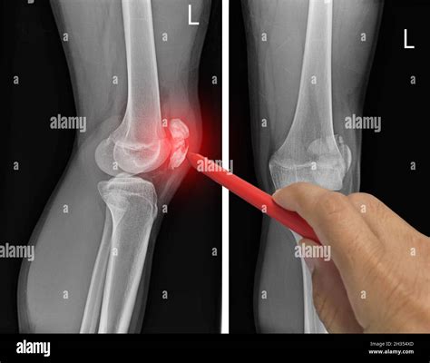 Close up X-ray knee AP-Lateral showing fracture patella or knee cap. pain in a man, Doctor ...