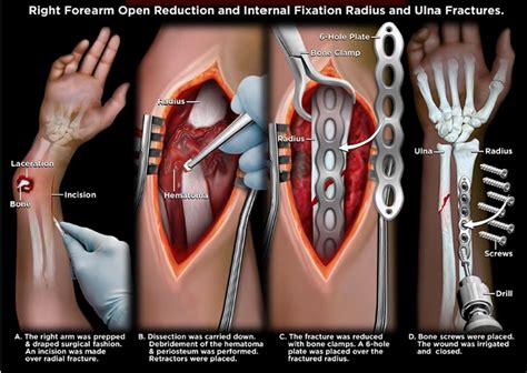 Image result for Open Fracture Surgery