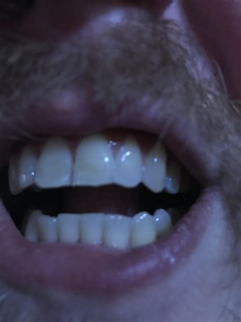 Is my tooth slightly “chipped” : r/askadentist