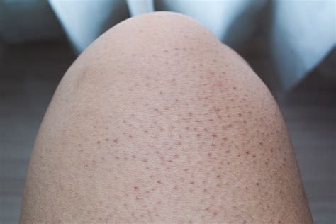 Best Skincare Treatments for Keratosis Pilaris (Chicken Skin)