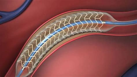 Brain stents show big promise for certain stroke patients | Fox News