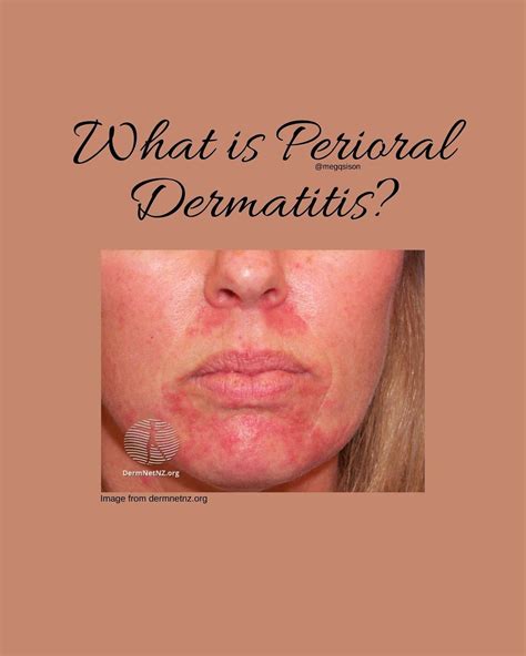Perioral Dermatitis And Colloidal Silver at Walter Paul blog