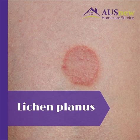Lichen Planus Causes List – Lichen Plan Causes – TEPEHL