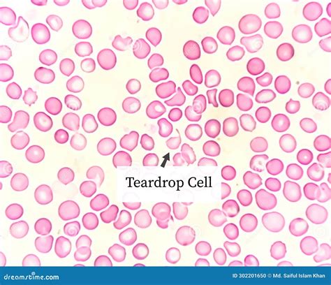 Teardrop Cells (dacrocytes) are Frequently Associated with Infiltration ...