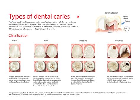 Classification of caries by the American Dental Association ...