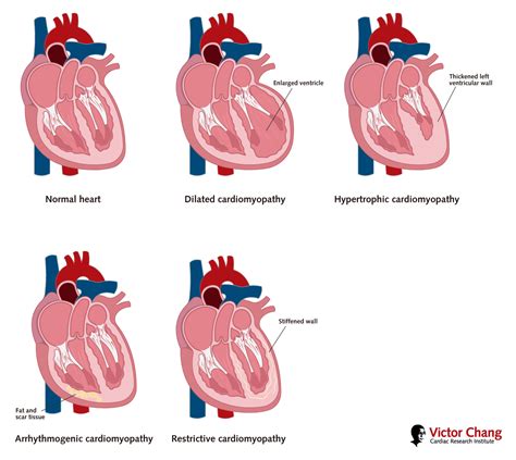 Thickening Of The Heart Dilated Cardiomyopathy (DCM) BHF