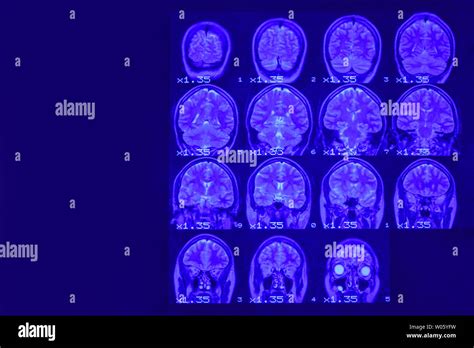 Brain CT Scan 的图像结果