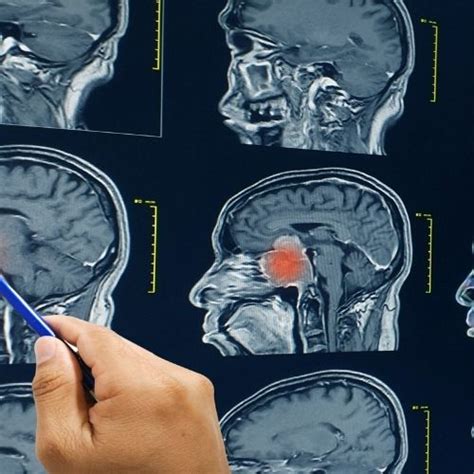 Brain Abscess/ Brain Injury Pathophysiology - HealthFinder