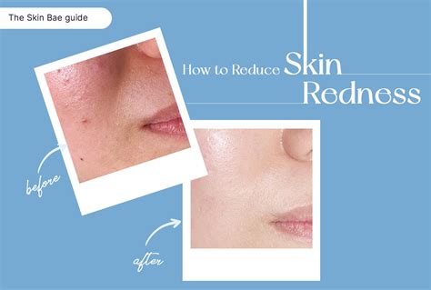 How to Reduce Skin Redness