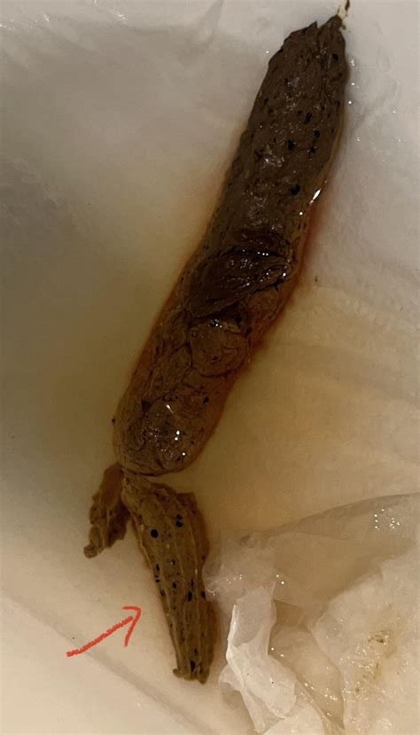 Feces With White Specks