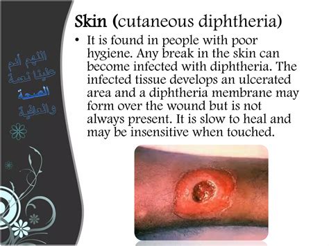 Diphtheria | PDF