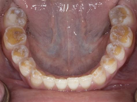 Kuvatulokset haulle celiac dental