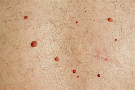 Cherry angioma: चेरी एंजियोमा के बारे में जानें - हैलो स्वास्थ्य