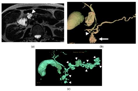 The Role of Magnetic Resonance Imaging (MRI) in the Diagnosis of Pancreatic Cystic Lesions (PCLs)