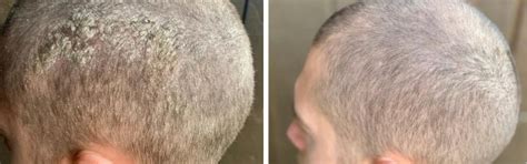 Scalp Psoriasis and Dermatitis 3 Step Care Bundle – Oleum Cottage