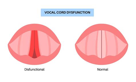 Vocal Cord Dysfunction: Causes, Symptoms, and Care