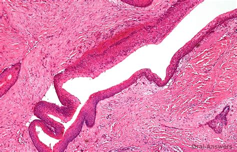 Odontogenic Keratocyst: Overview and Treatment | Oral Answers