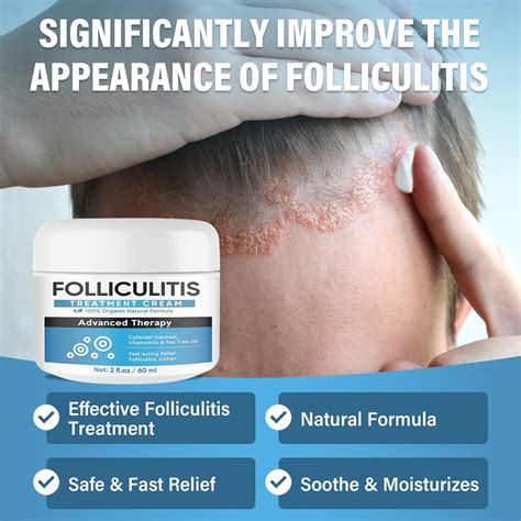 Folliculitis Treatment Cream, Effective Folliculitis Australia | Ubuy