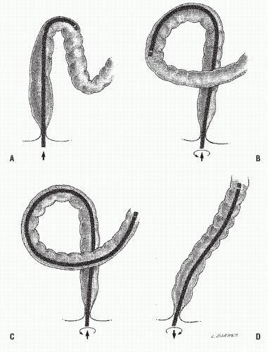 Image result for Colonoscopy Loop